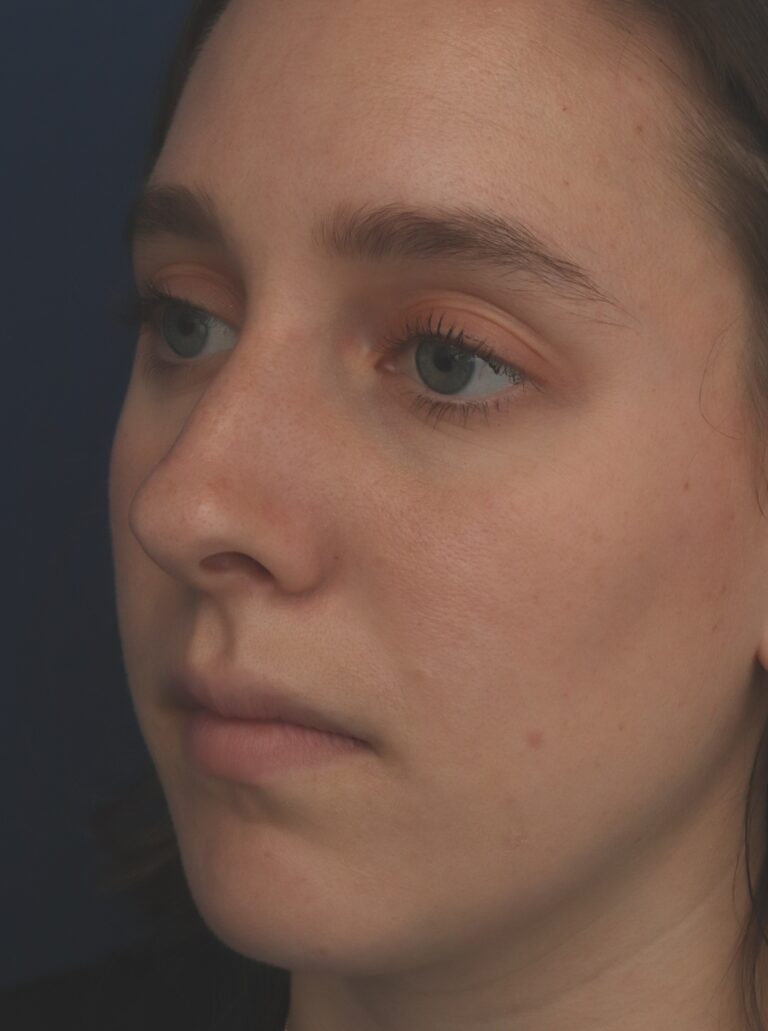 Before Image: Rhinoplasty - left-front-oblique