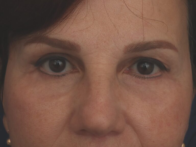 After Image: Deep Plane Facelift - other