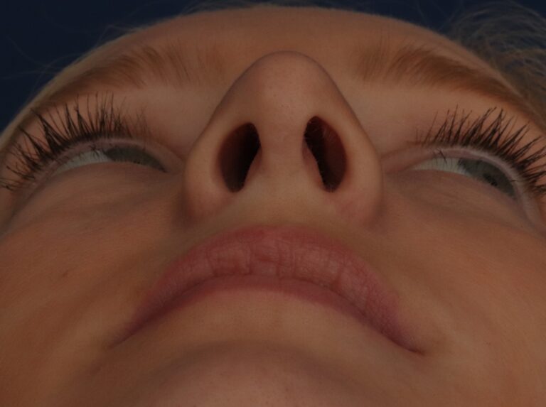 After Image: Septorhinoplasty - other