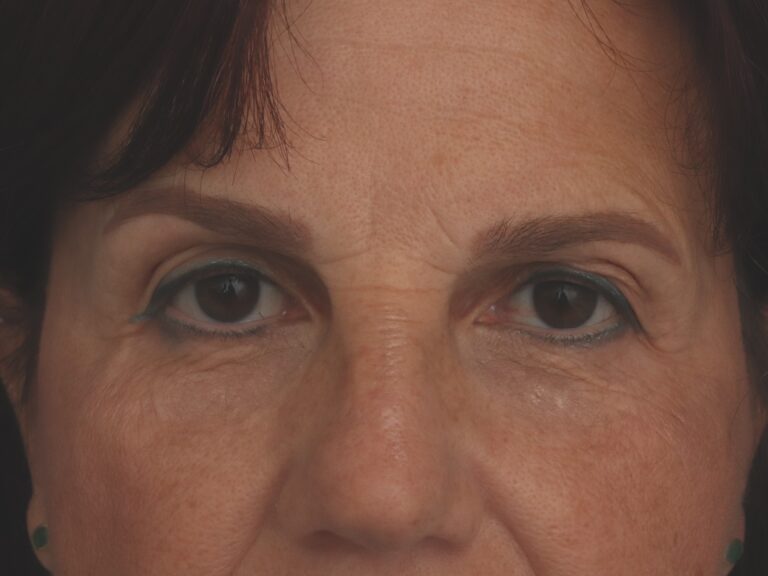 Before Image: Deep Plane Facelift - other