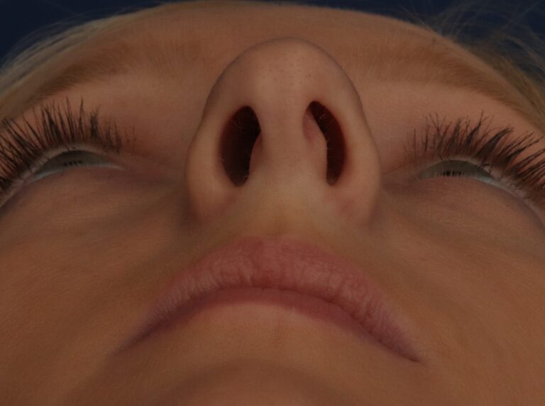 Before Image: Septorhinoplasty - other