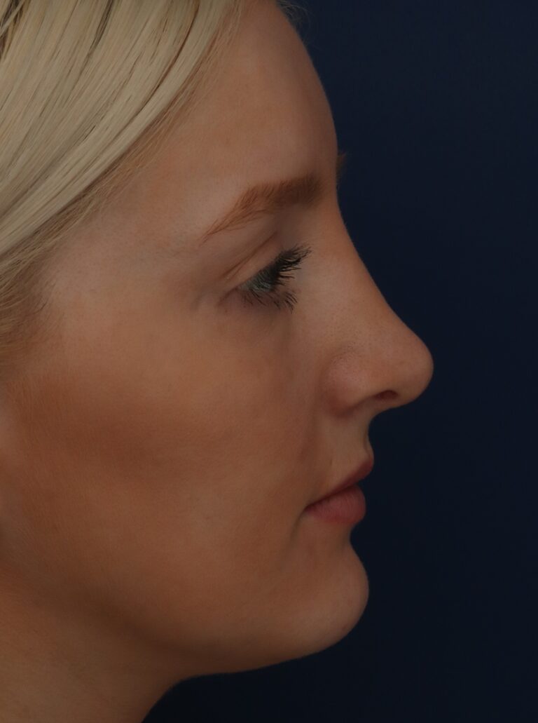After Image: Septorhinoplasty - right-side