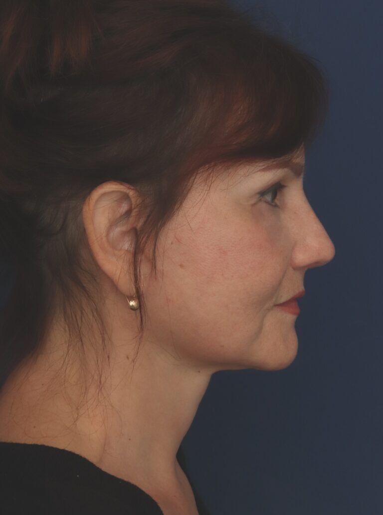 After Image: Deep Plane Facelift - right-side