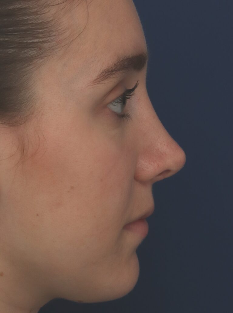 After Image: Rhinoplasty - right-side