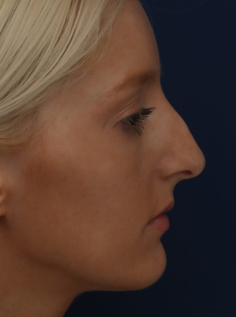 Before Image: Septorhinoplasty - right-side