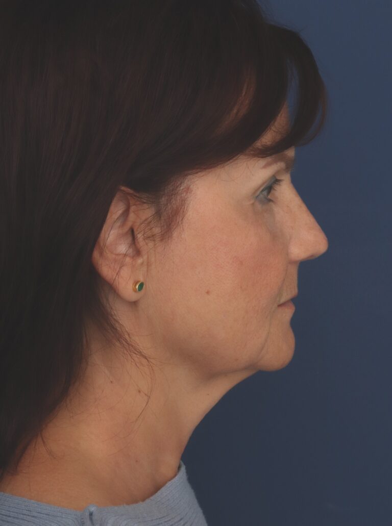 Before Image: Deep Plane Facelift - right-side