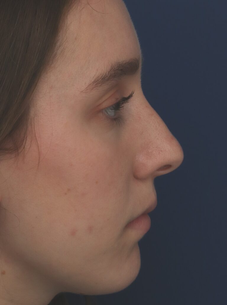 Before Image: Rhinoplasty - right-side