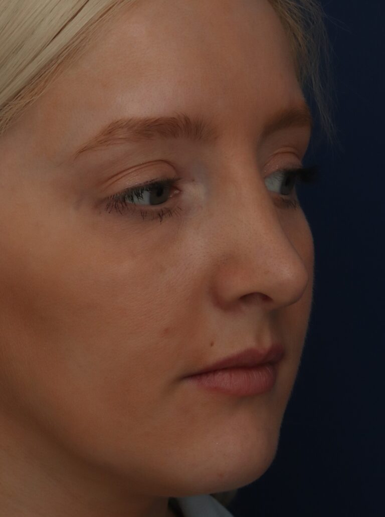 After Image: Septorhinoplasty - right-front-oblique