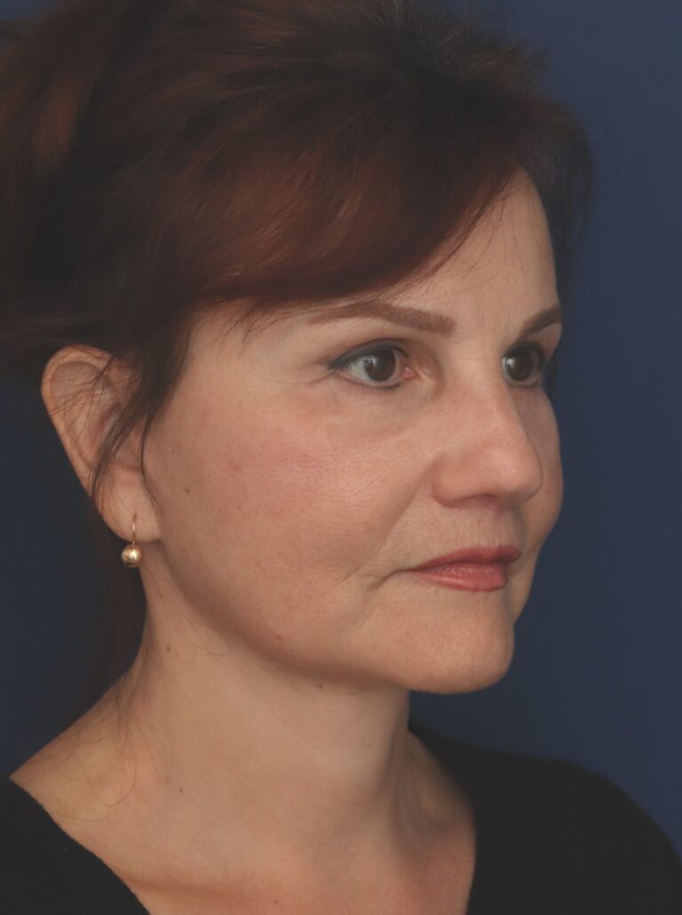 After Image: Deep Plane Facelift - right-front-oblique