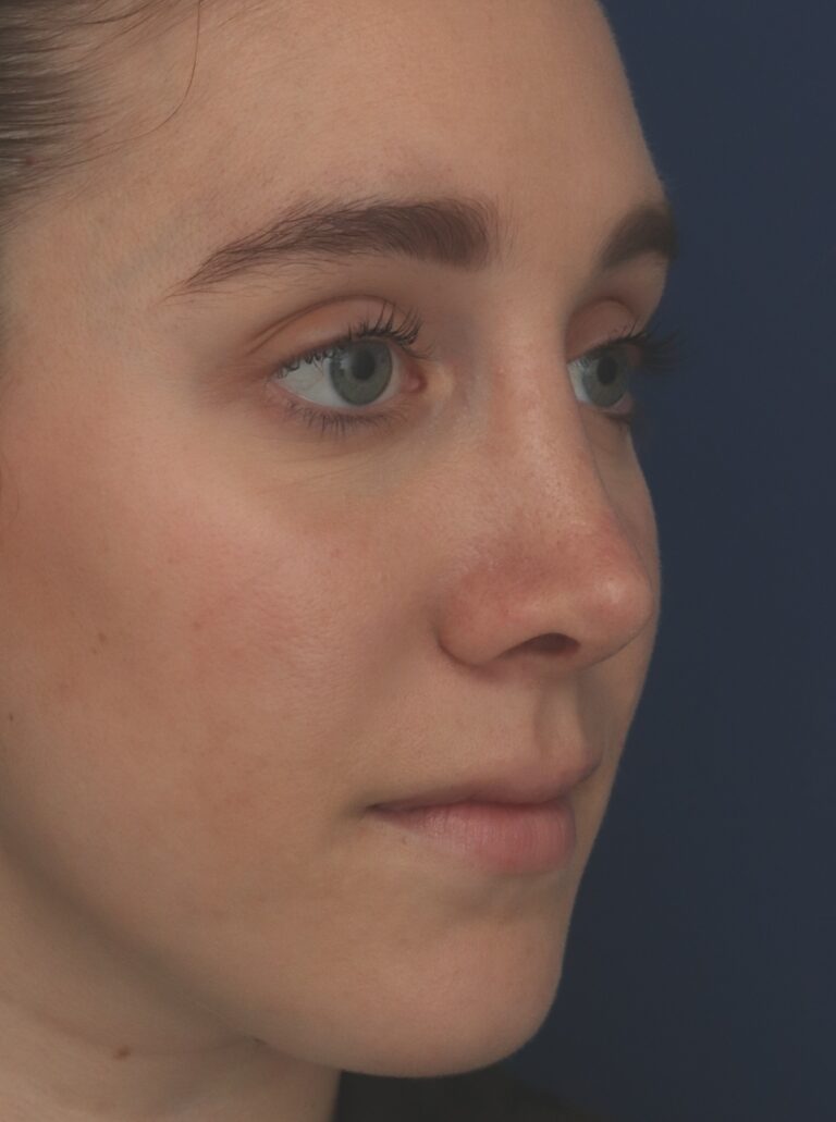After Image: Rhinoplasty - right-front-oblique