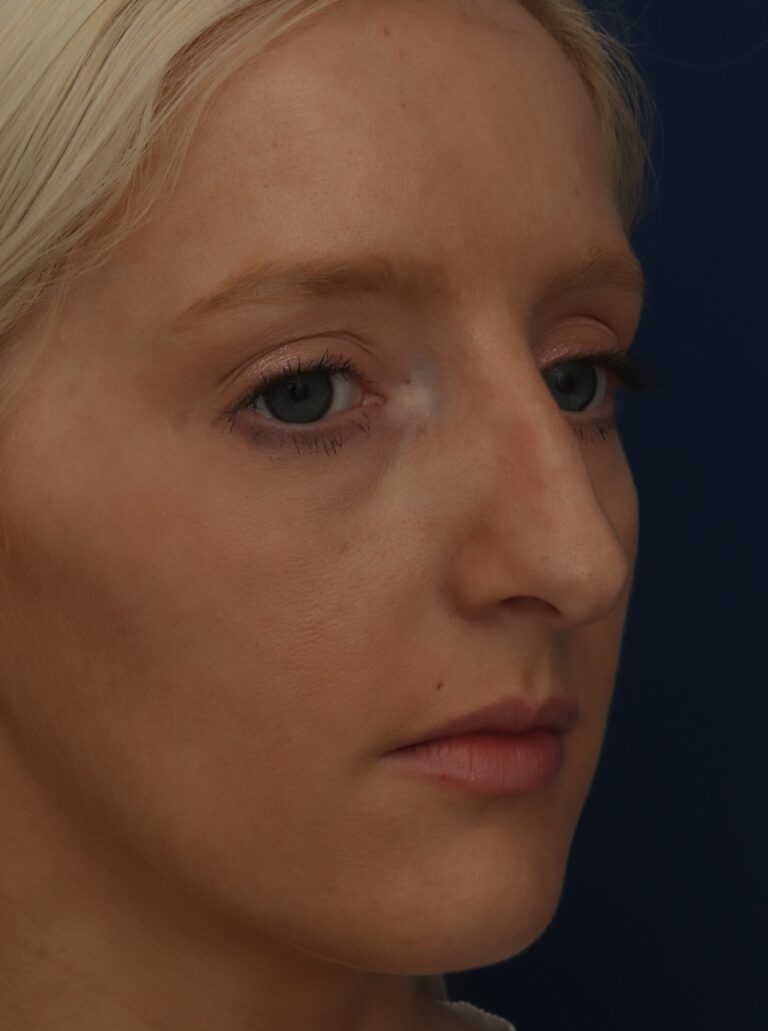 Before Image: Septorhinoplasty - right-front-oblique