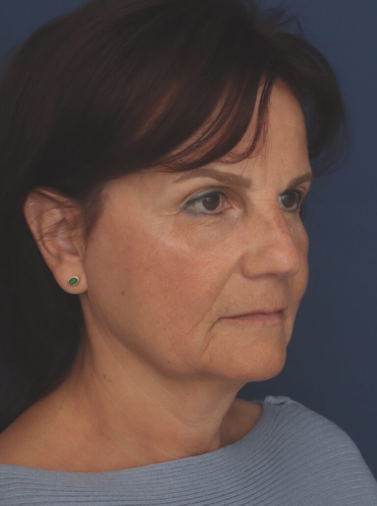 Before Image: Deep Plane Facelift - right-front-oblique