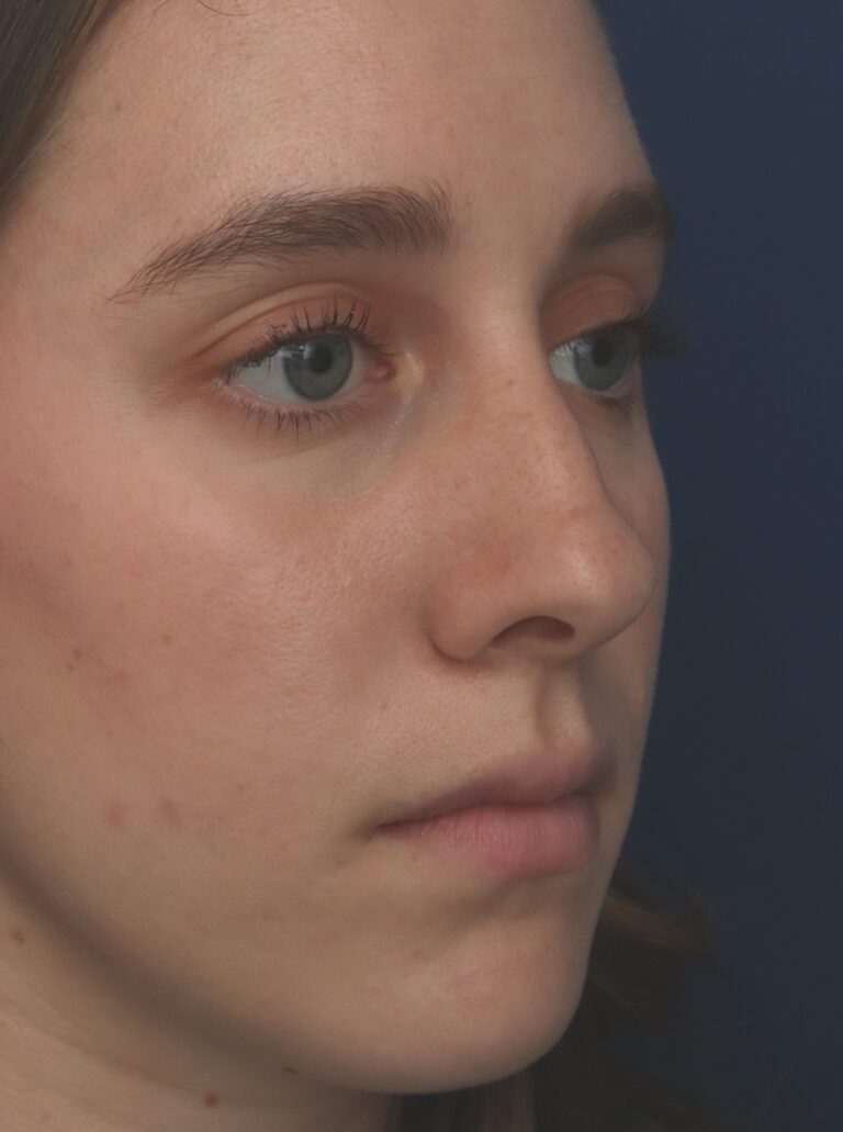 Before Image: Rhinoplasty - right-front-oblique