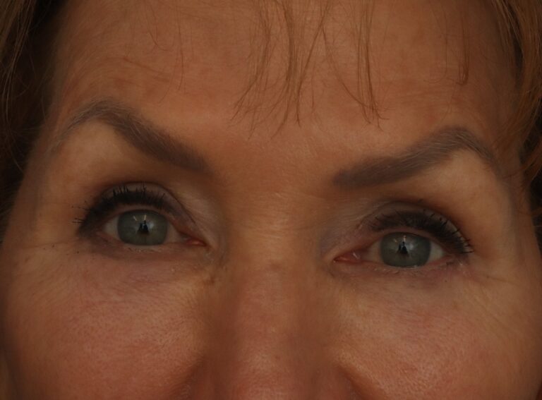 After Image: Eyelid Surgery - front