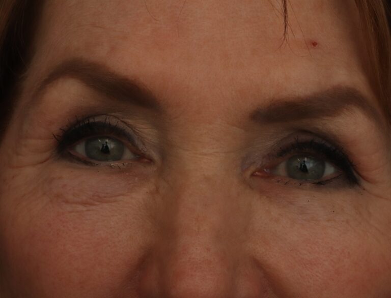 Before Image: Eyelid Surgery - front