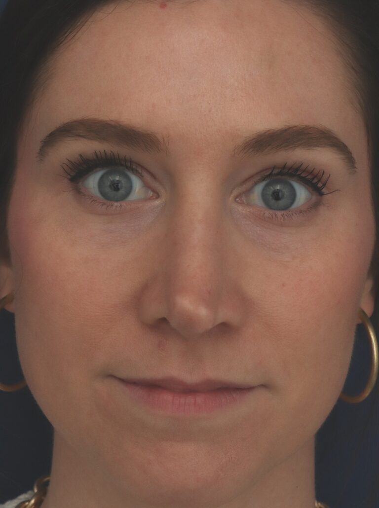 Before Image: Rhinoplasty - front