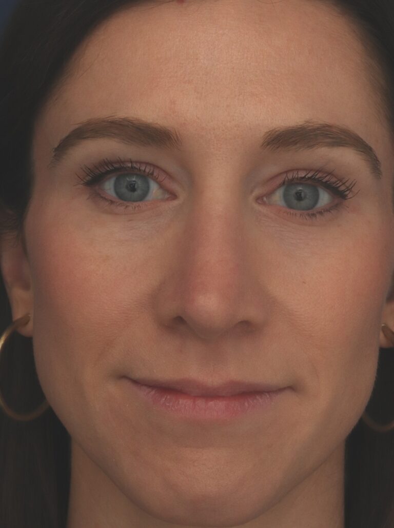 After Image: Rhinoplasty - front