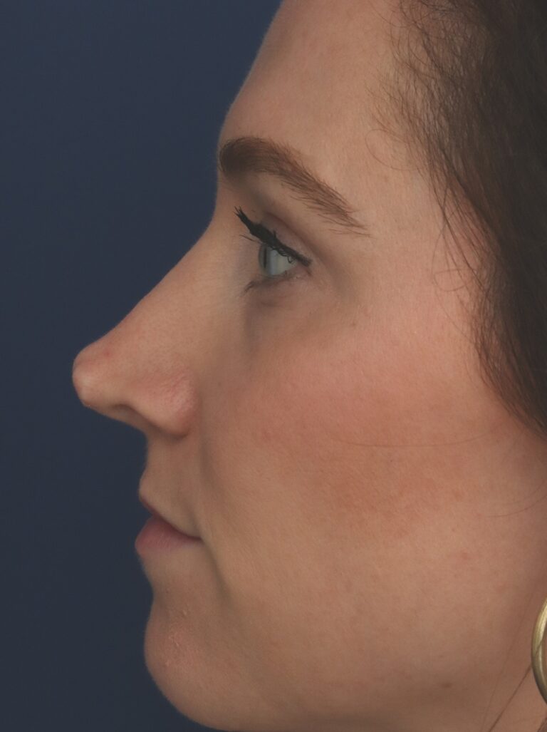 Before Image: Rhinoplasty - left-side
