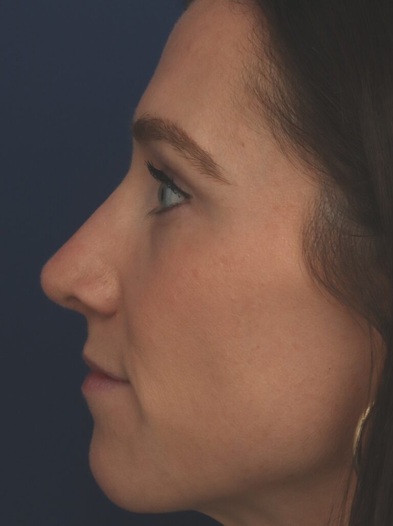 After Image: Rhinoplasty - left-side
