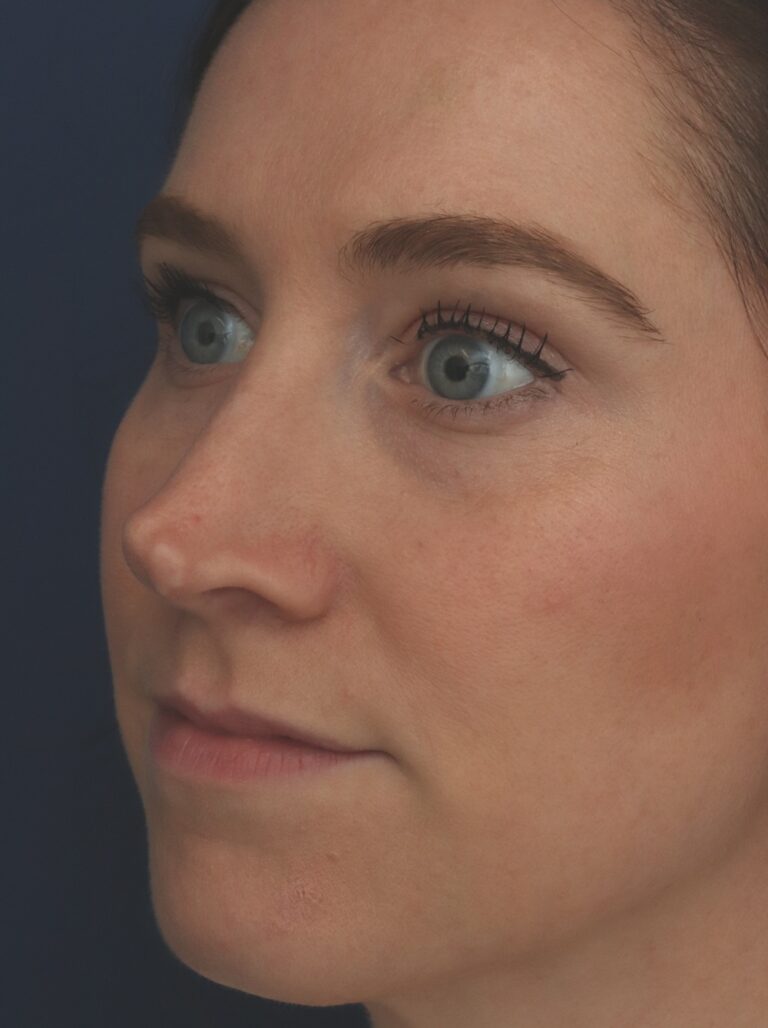Before Image: Rhinoplasty - left-front-oblique