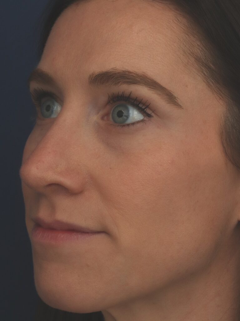 After Image: Rhinoplasty - left-front-oblique