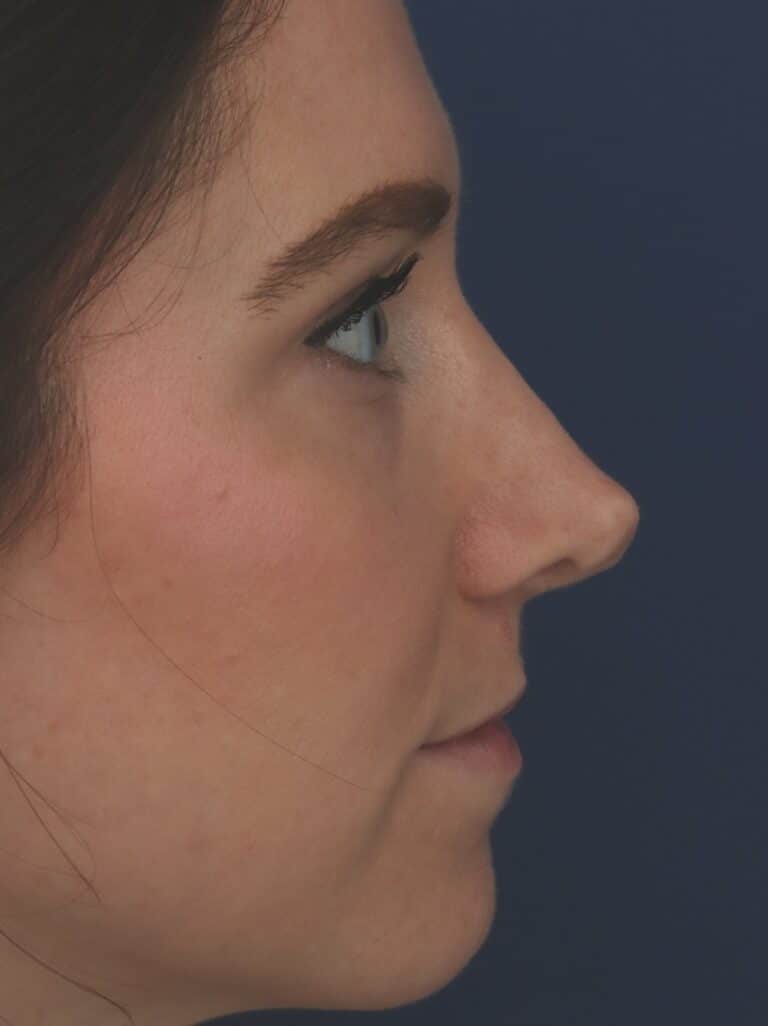 Before Image: Rhinoplasty - right-side