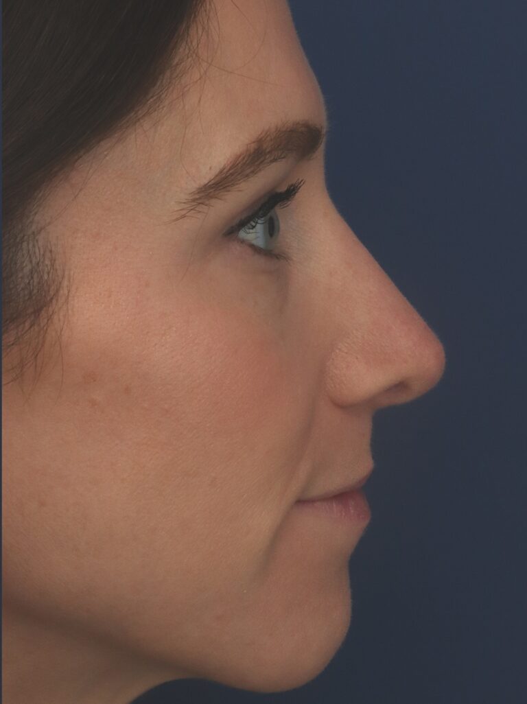 After Image: Rhinoplasty - right-side
