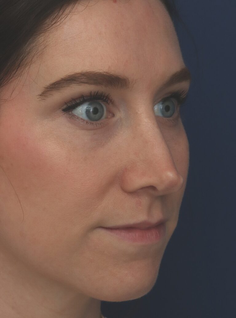 Before Image: Rhinoplasty - right-front-oblique