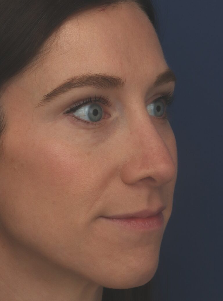 After Image: Rhinoplasty - right-front-oblique