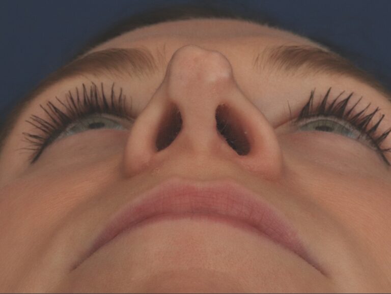 Before Image: Rhinoplasty - front