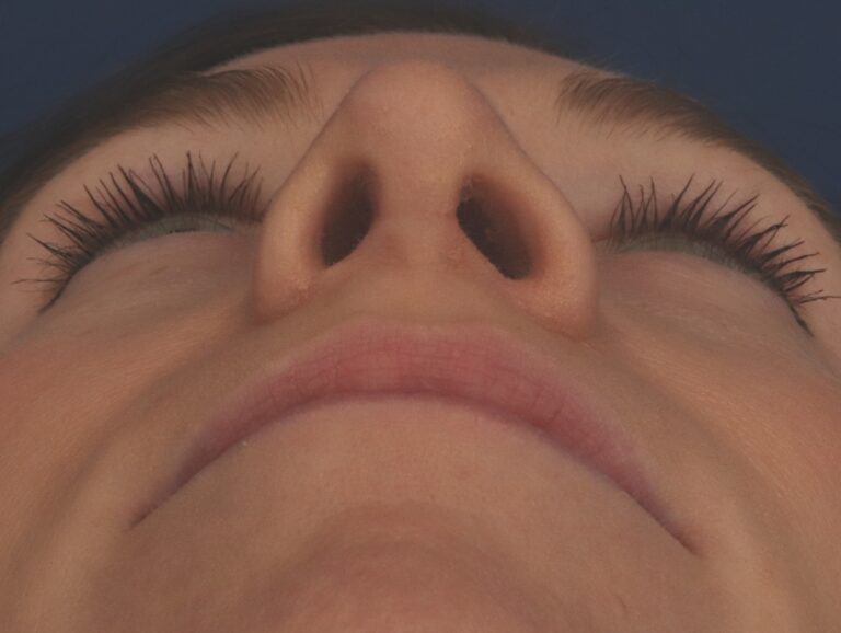 After Image: Rhinoplasty - front