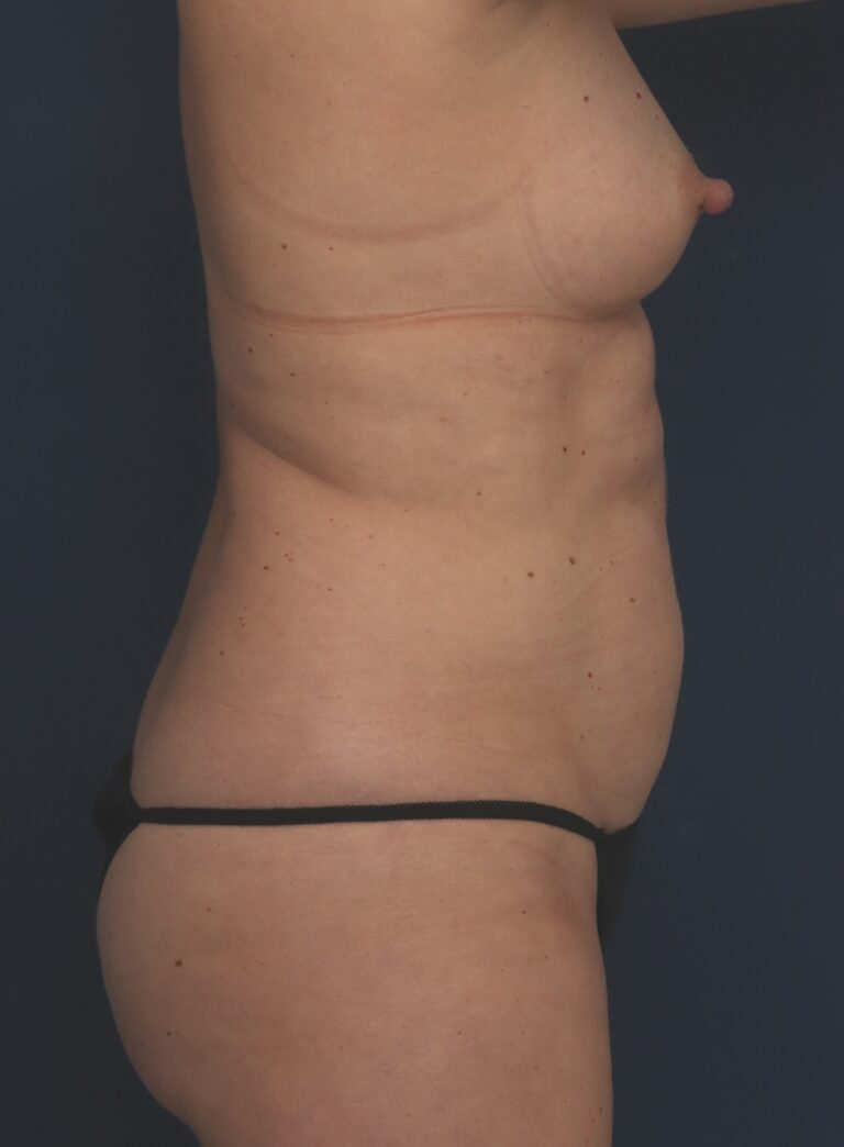 Before Image: Liposuction/Abdominoplasty - right-side