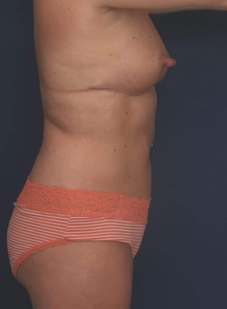 After Image: Liposuction/Abdominoplasty - right-side