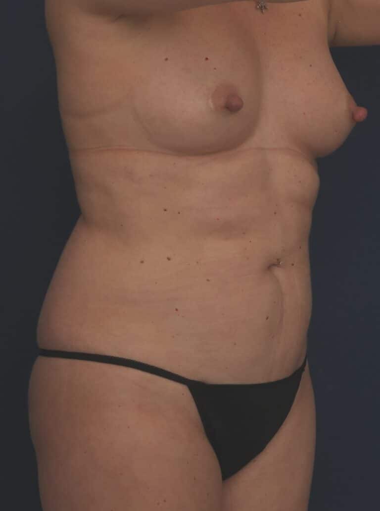 Before Image: Liposuction/Abdominoplasty - right-front-oblique