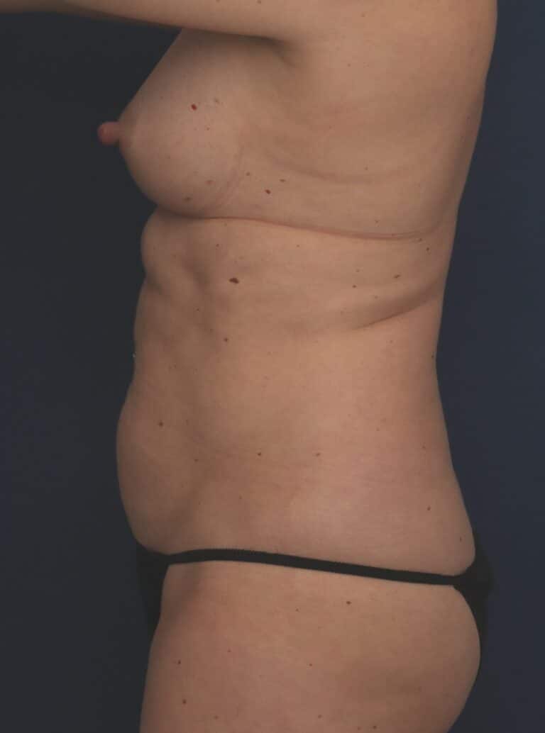 Before Image: Liposuction/Abdominoplasty - left-side