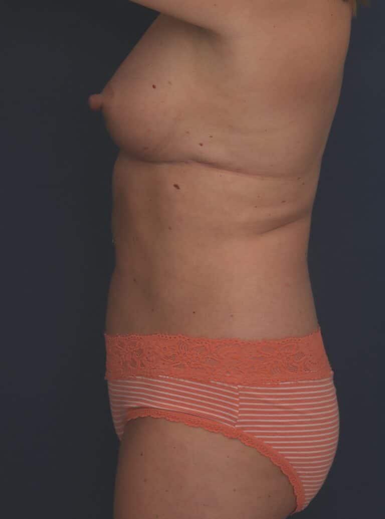 After Image: Liposuction/Abdominoplasty - left-side