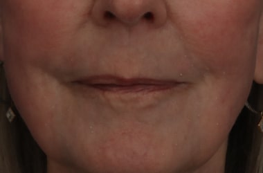 After Image: Laser Resurfacing - front
