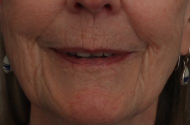 Before Image: Laser Resurfacing - front