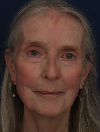 After Image: Laser Resurfacing - front