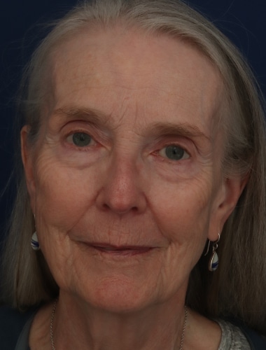 Before Image: Laser Resurfacing - front