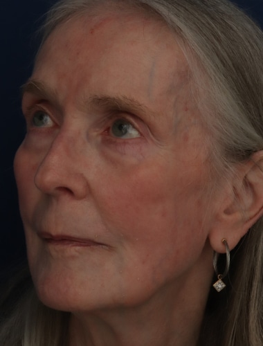 After Image: Laser Resurfacing - left-front-oblique