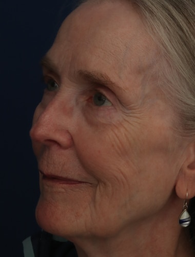 Before Image: Laser Resurfacing - left-front-oblique