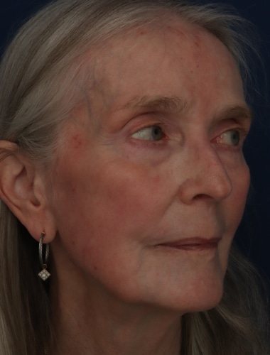 After Image: Laser Resurfacing - right-front-oblique