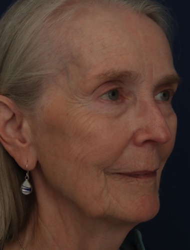 Before Image: Laser Resurfacing - right-front-oblique
