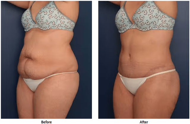 Before-and-after tummy tuck results shown side by side, with the patient before surgery on the left and after surgery on the right.