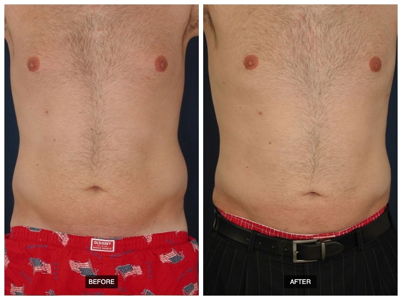 Side-by-side images of a man’s torso showing before-and-after results of male liposuction in Baltimore