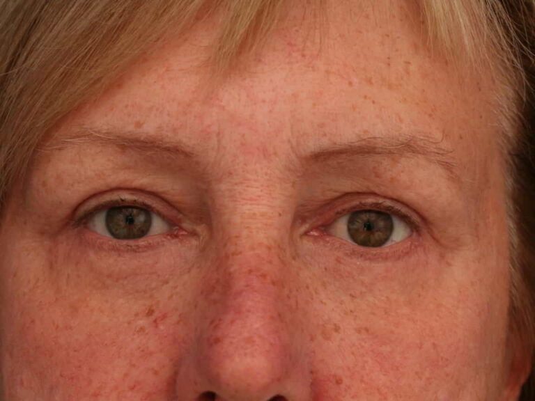 After Image: Eyelid Surgery - front