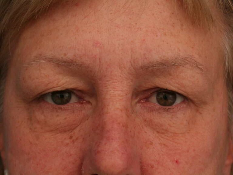 Before Image: Eyelid Surgery - front