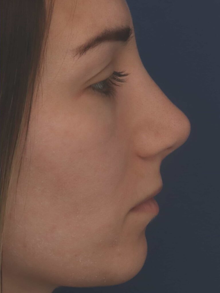 Before Image: Rhinoplasty - left-side