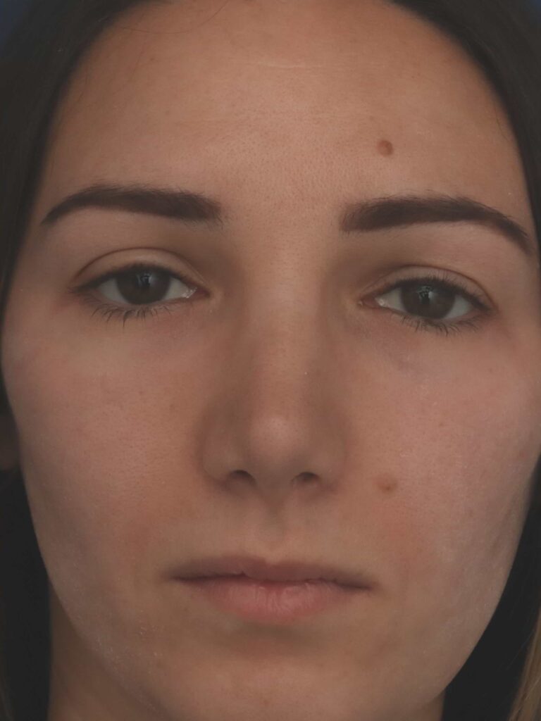 After Image: Rhinoplasty - front